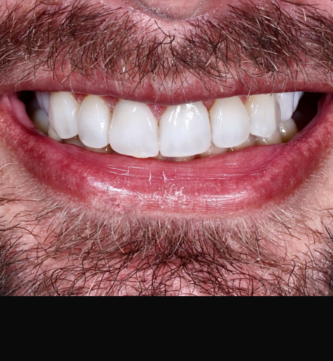 Depois - Facetas em Resina