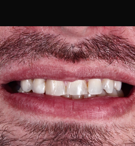 Antes - Facetas em Resina