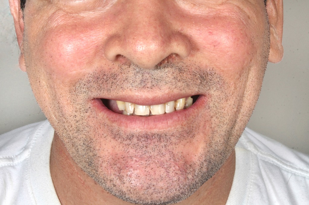Dentes anteriores antes da reabilitação