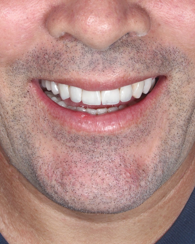 Dentes anteriores após reabilitação e facetas