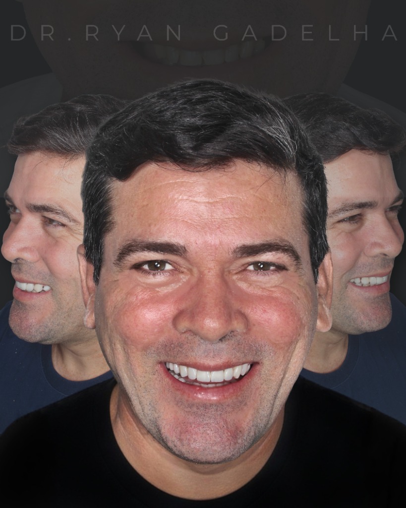 Resultado Final do Tratamento - Reabilitação Posterior e Facetas