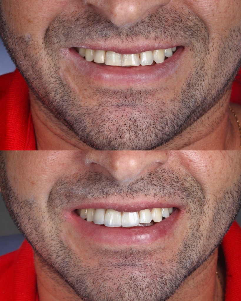 Antes e Depois - Reabilitação Oral e Facetas Estéticas