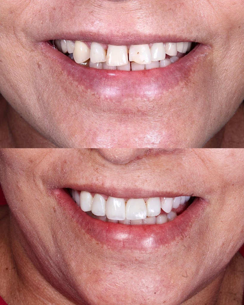 Antes e Depois - Reabilitação com Facetas Estéticas