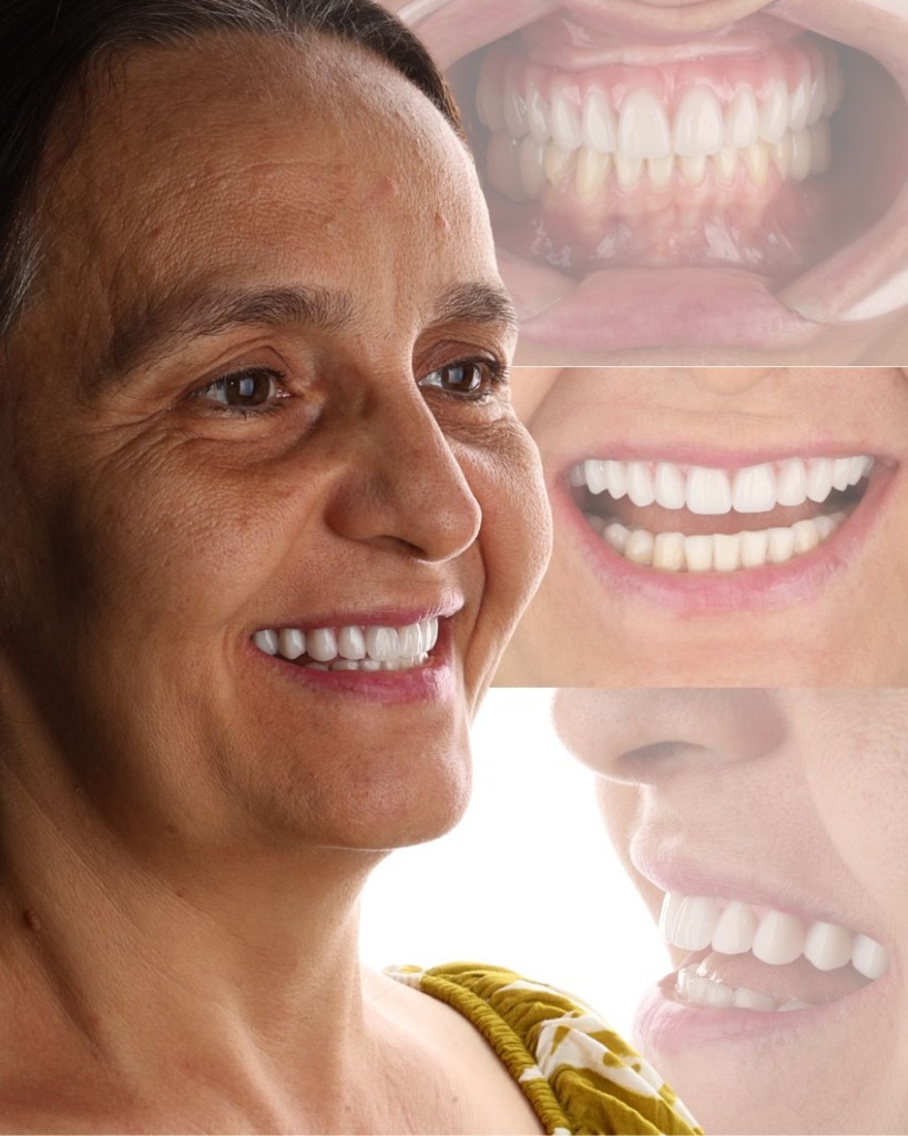 Reabilitação com Implantes Dentários - Dr. Ryan Gadelha