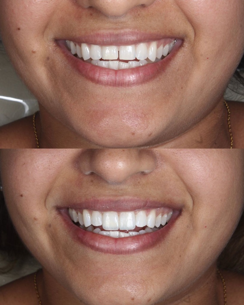 Antes e Depois - Fechamento de Diastema com Facetas